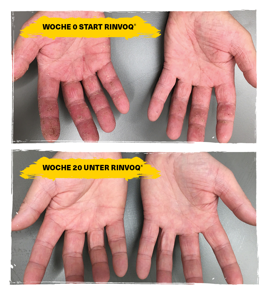 Woche 0 Start Rinvoq und Woche 20 unter Rinvoq